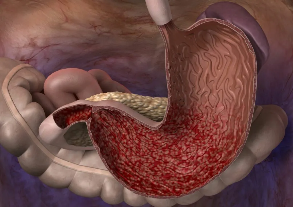 Ontsteking van het maagslijmvlies (gastritis) bij honden